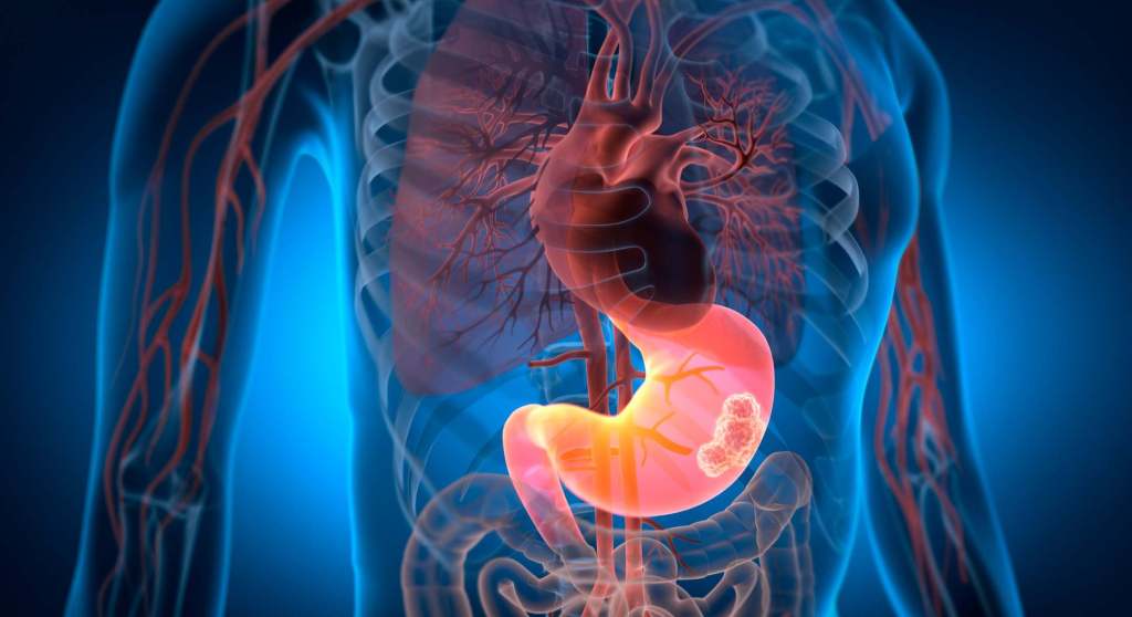 Asociación Mexicana de Gastroenterología hace un llamado a atender bacteria vinculada al cáncer&nbsp;gástrico